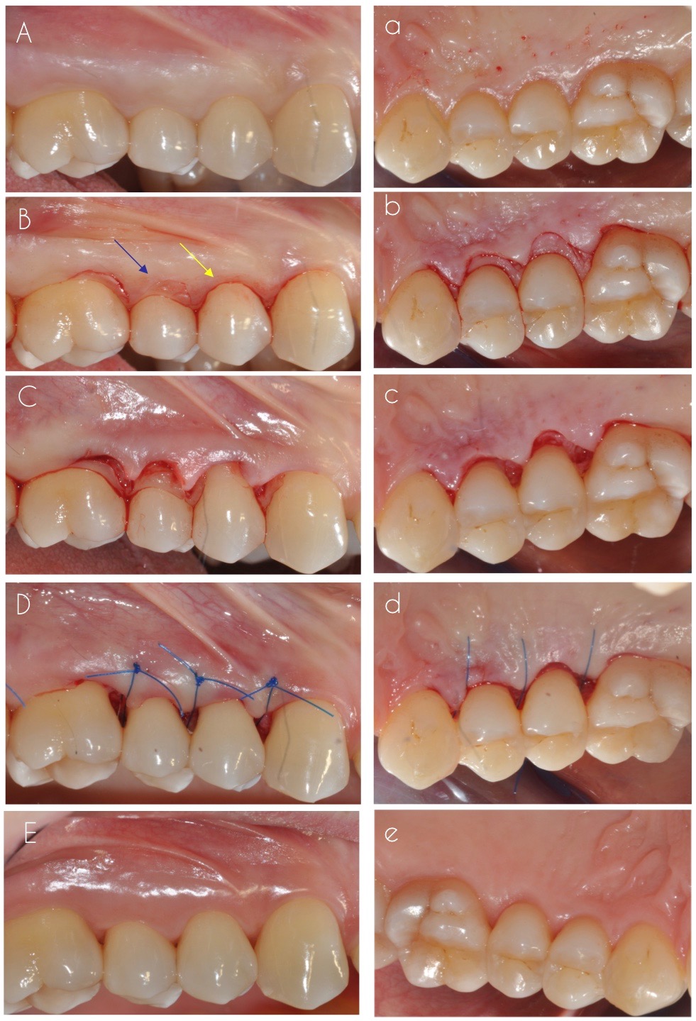 Unraveling the dilemma of the Modified Widman flap. What do we really